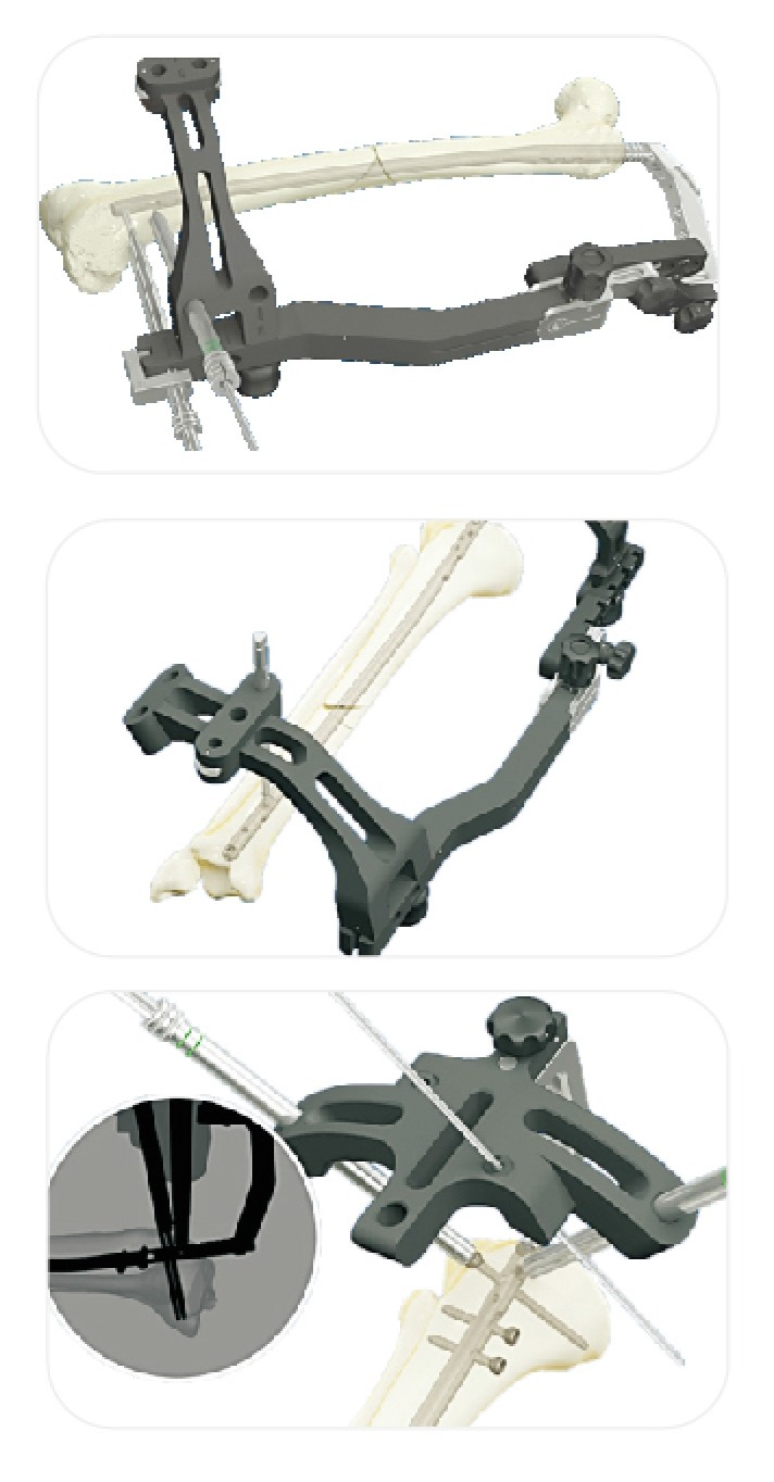 PEEK targeting device for trauma surgery - JUNHUA ChinaPEEK